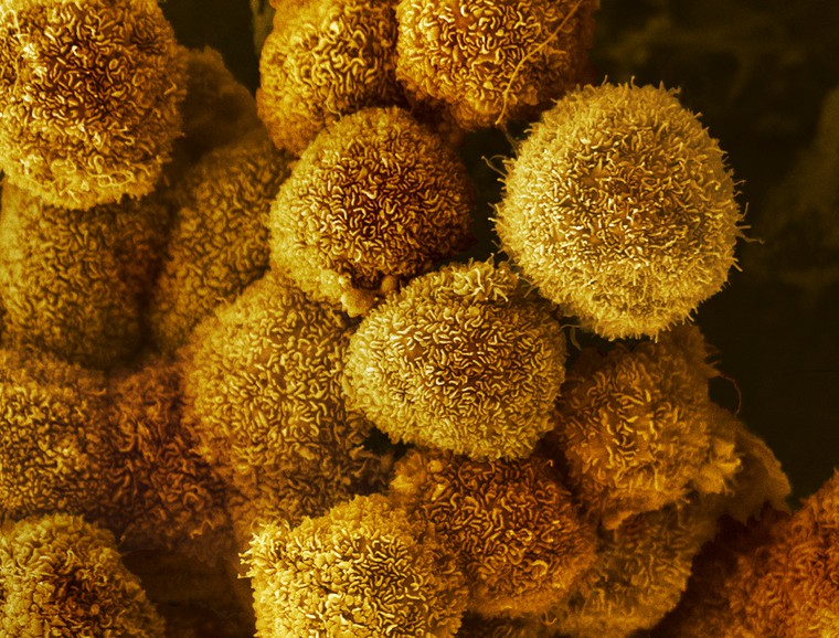 Pancreatic cancer cells - Anne Weston, Francis Crick Institute